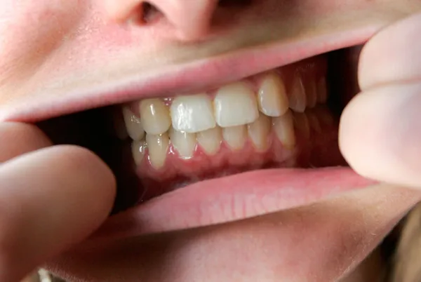 Strokovnjakinja razkrila, katera živila lahko povzročijo vnetje dlesni