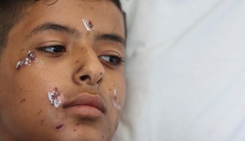 otrok, libanon, izrael, poškodovan