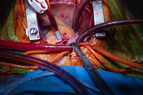 transplantacija srca