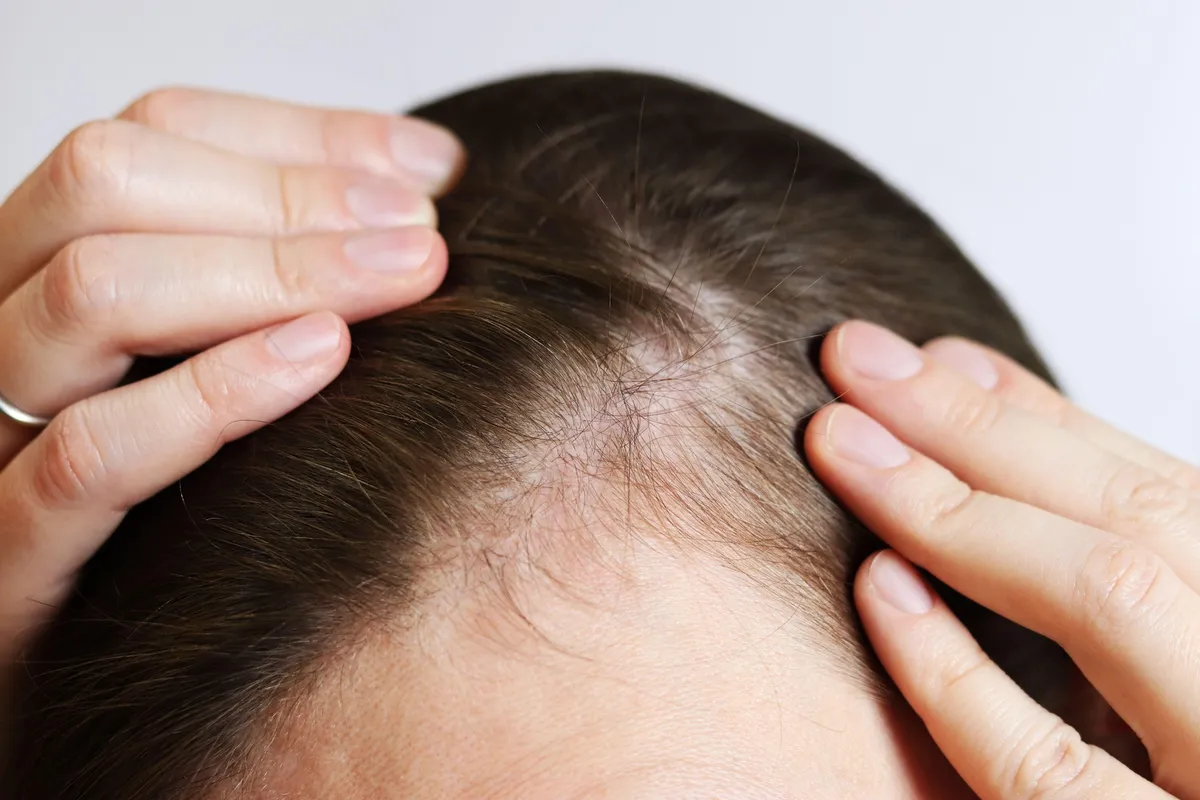 Po presaditvi las doživela nepričakovano posledico, ki je presenetila tudi zdravnike