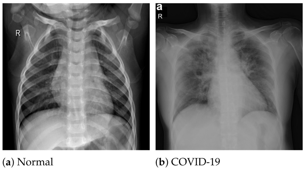 covid, rentgen, koronavirus