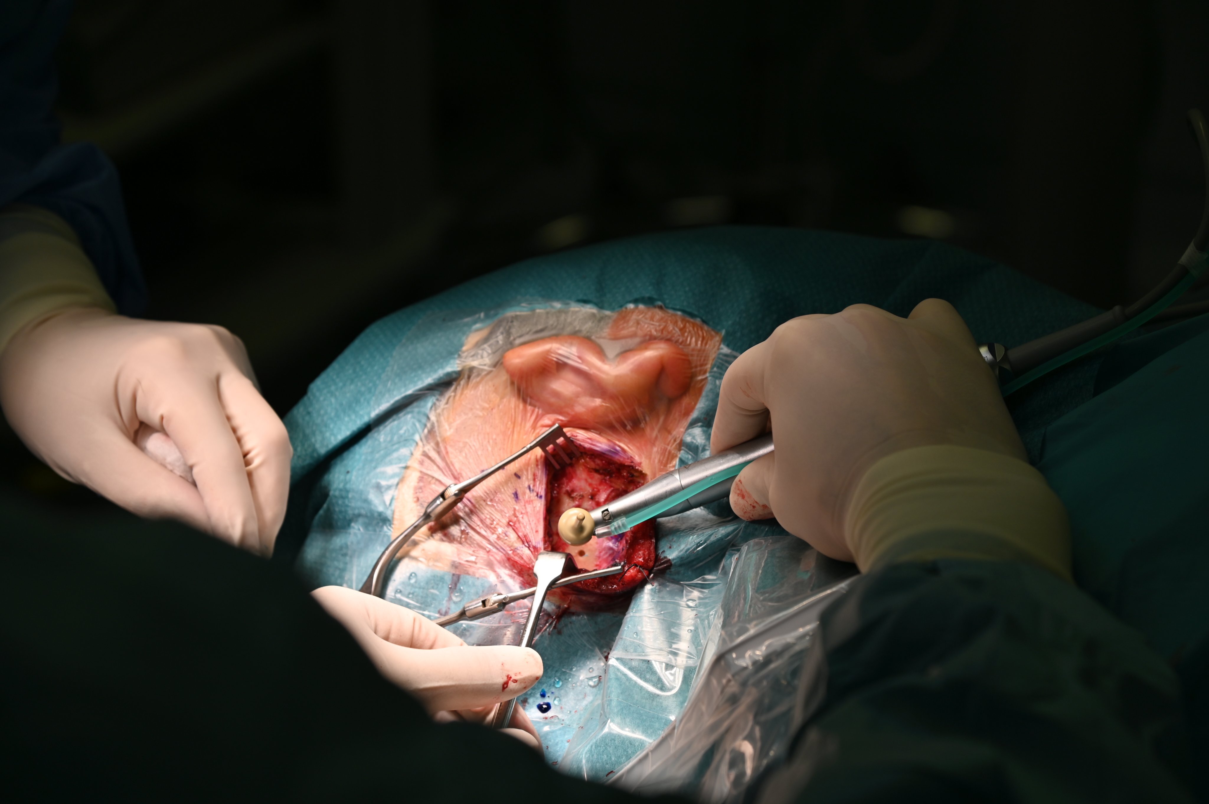 osia, implantat, operacija