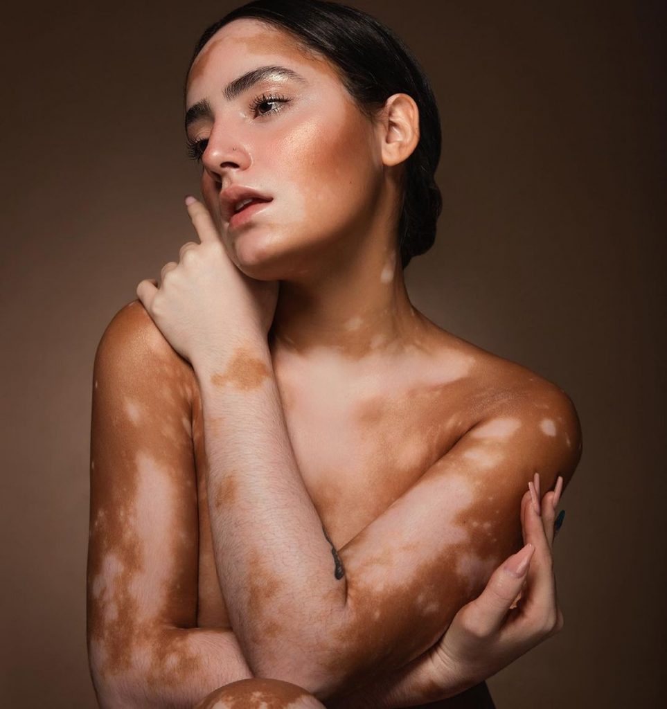 1658848486-izguba-pigmenta-vitiligo-5-963x1024.jpg
