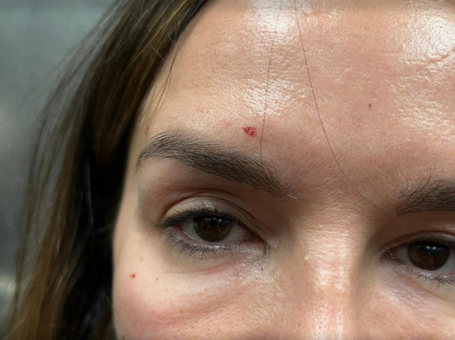 severina, telesne poškodbe