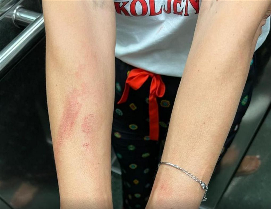 severina, telesne poškodbe