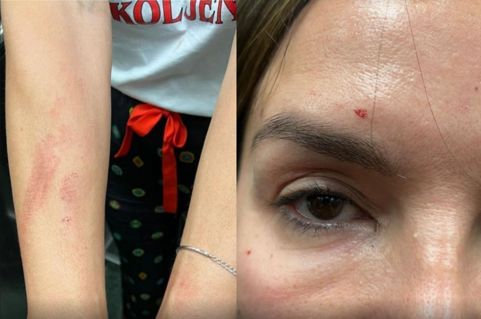 severina, telesne poškodbe