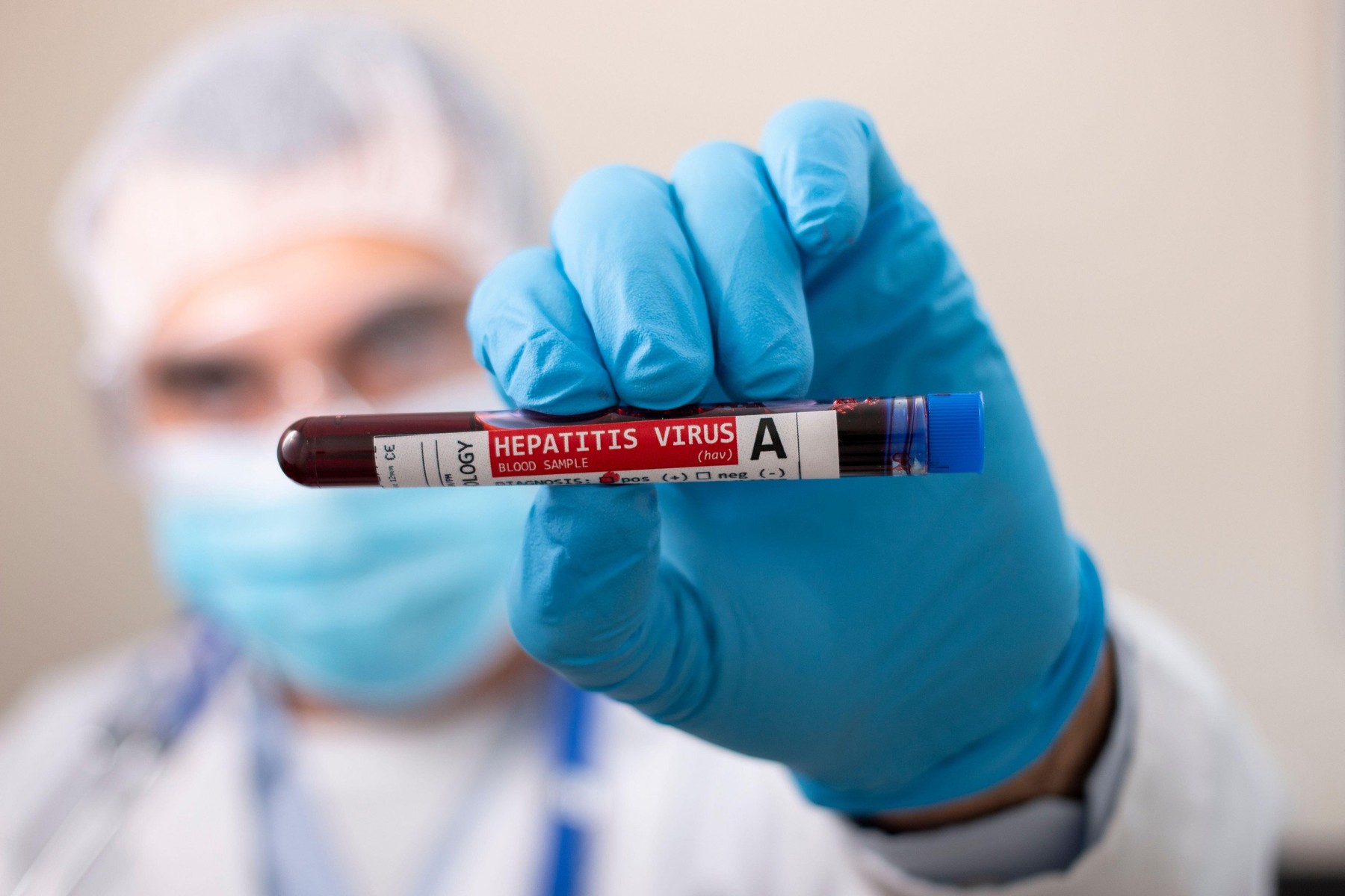 View of a doctor holding a fictional test tube blood sample, infected with Hepatitis A virus.