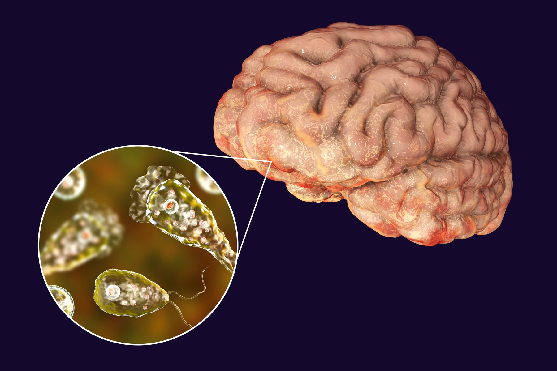 Brain-eating amoeba infection, illustration