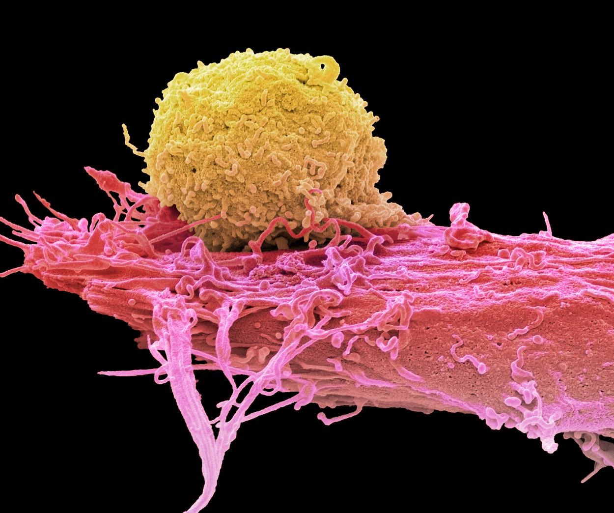 Terapija s celicami CAR-T