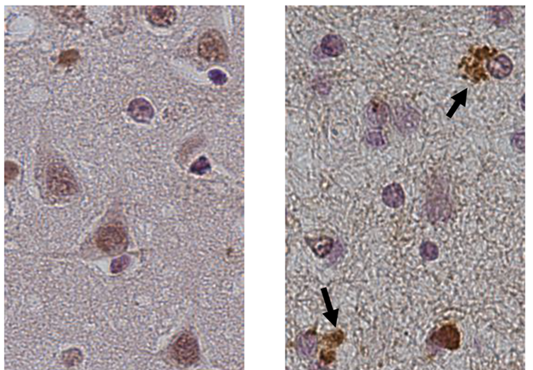 FUS v človeških možganih