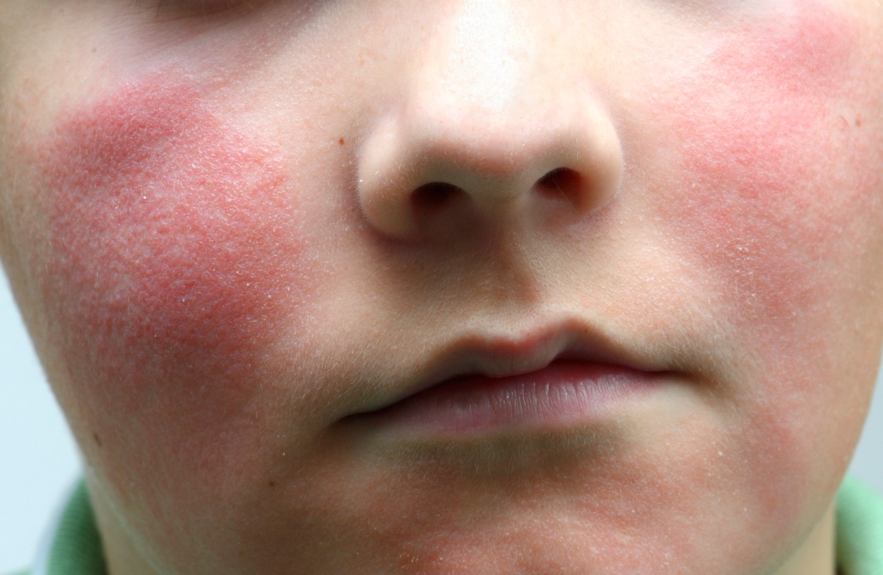 Peta bolezen, izpuščaj