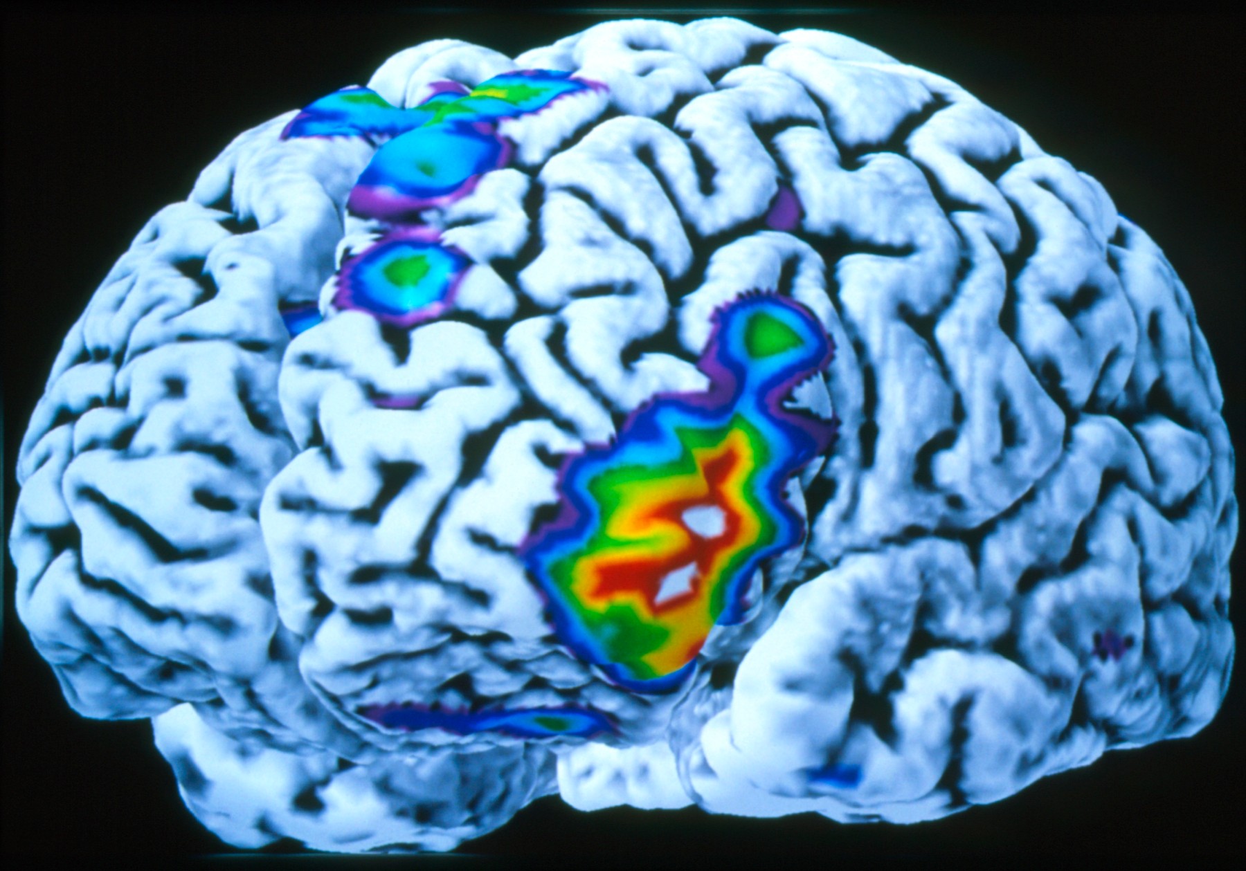 možgani, možganska aktivnost, MRI, PET, skeniranje