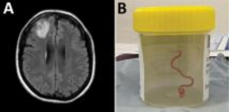 zajedalec, možgani,, Avstralija, parazit