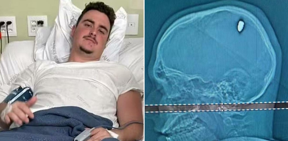 Mateus Facio, krogla, možgani, tomograf