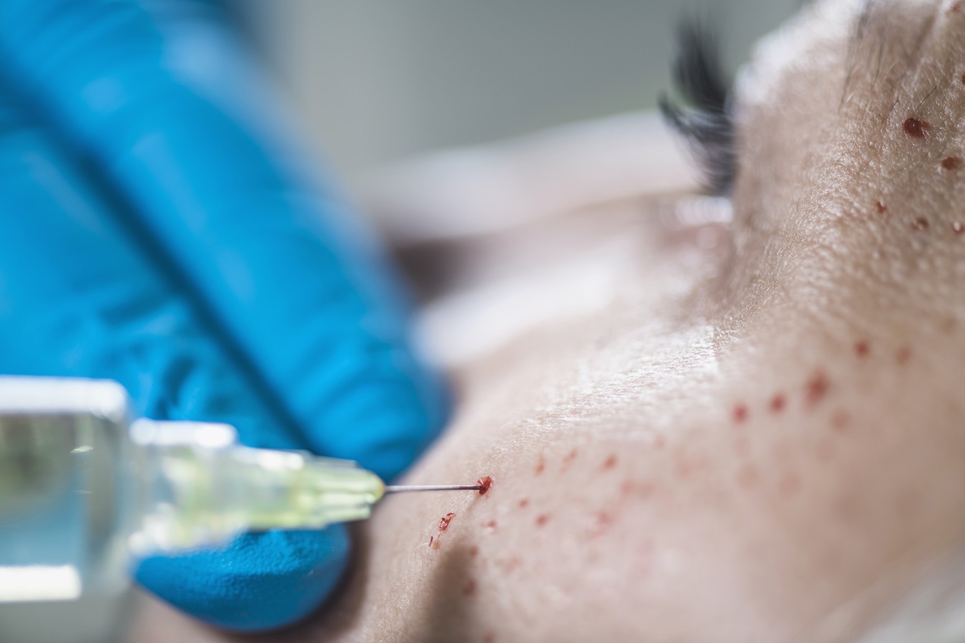 VAPIRSKI FACIAL, POMALJEVANJE, IGLA, LEPOTNI PPOSEG