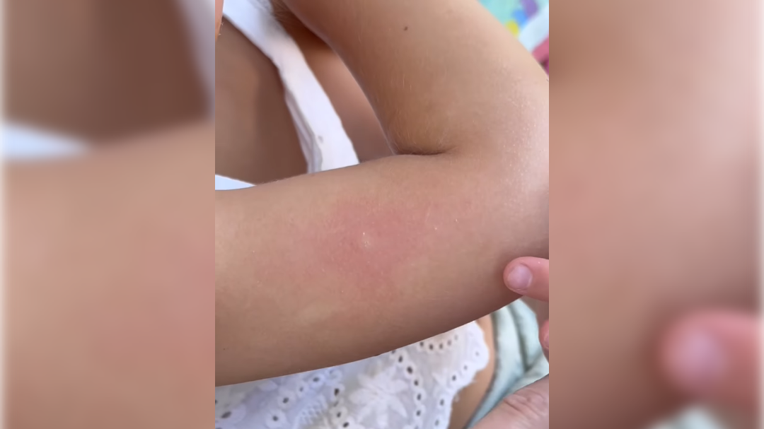 ugriz komarja, komarji