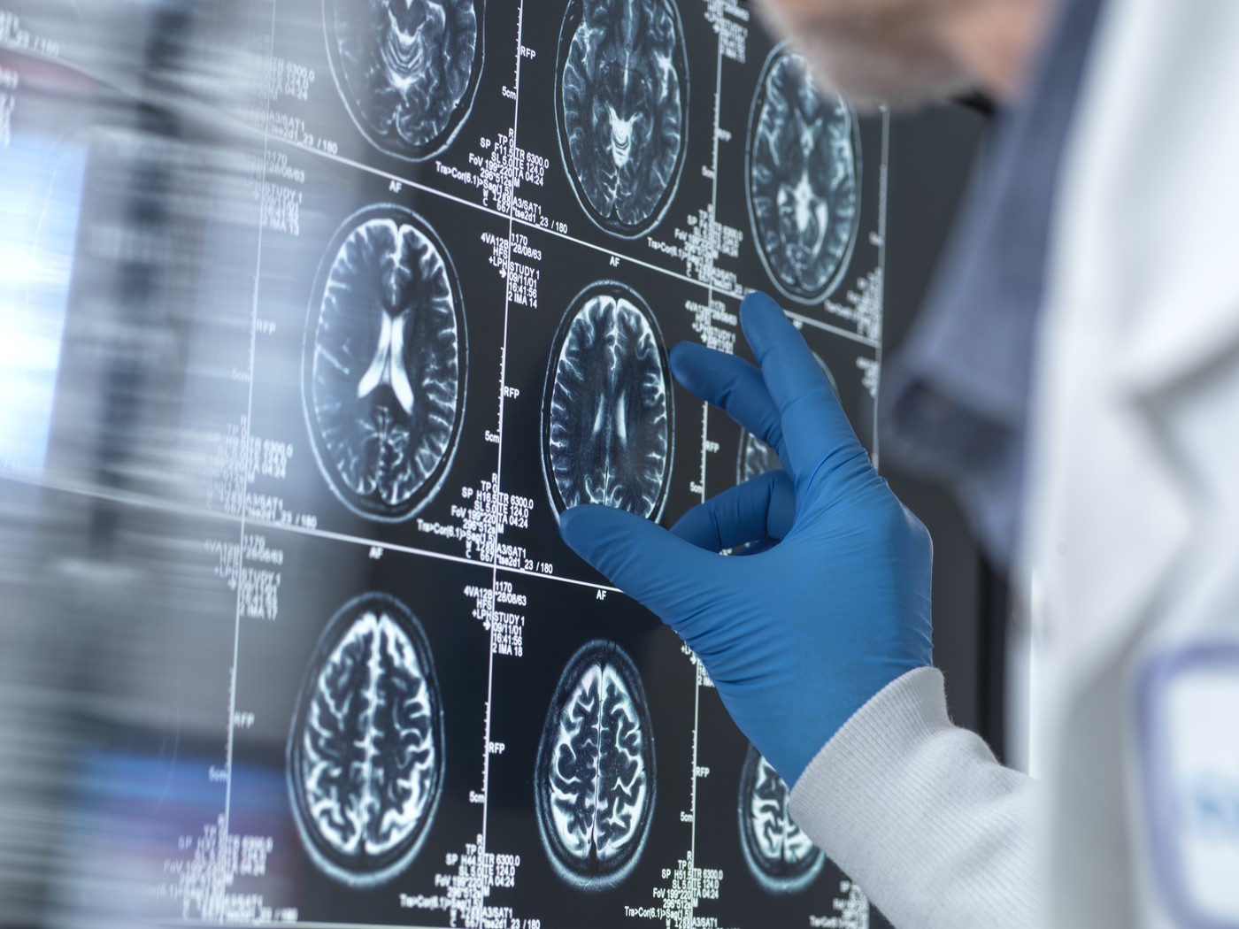 raziskava, alzheimerjeva bolezen, demenca