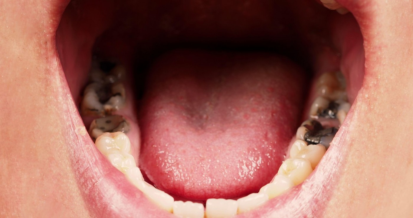 Decayed tooth root canal treatment. Tooth or teeth decay of lower molar. Restoration with a composite filling. Adult caries. bad teeth. Dental tempora