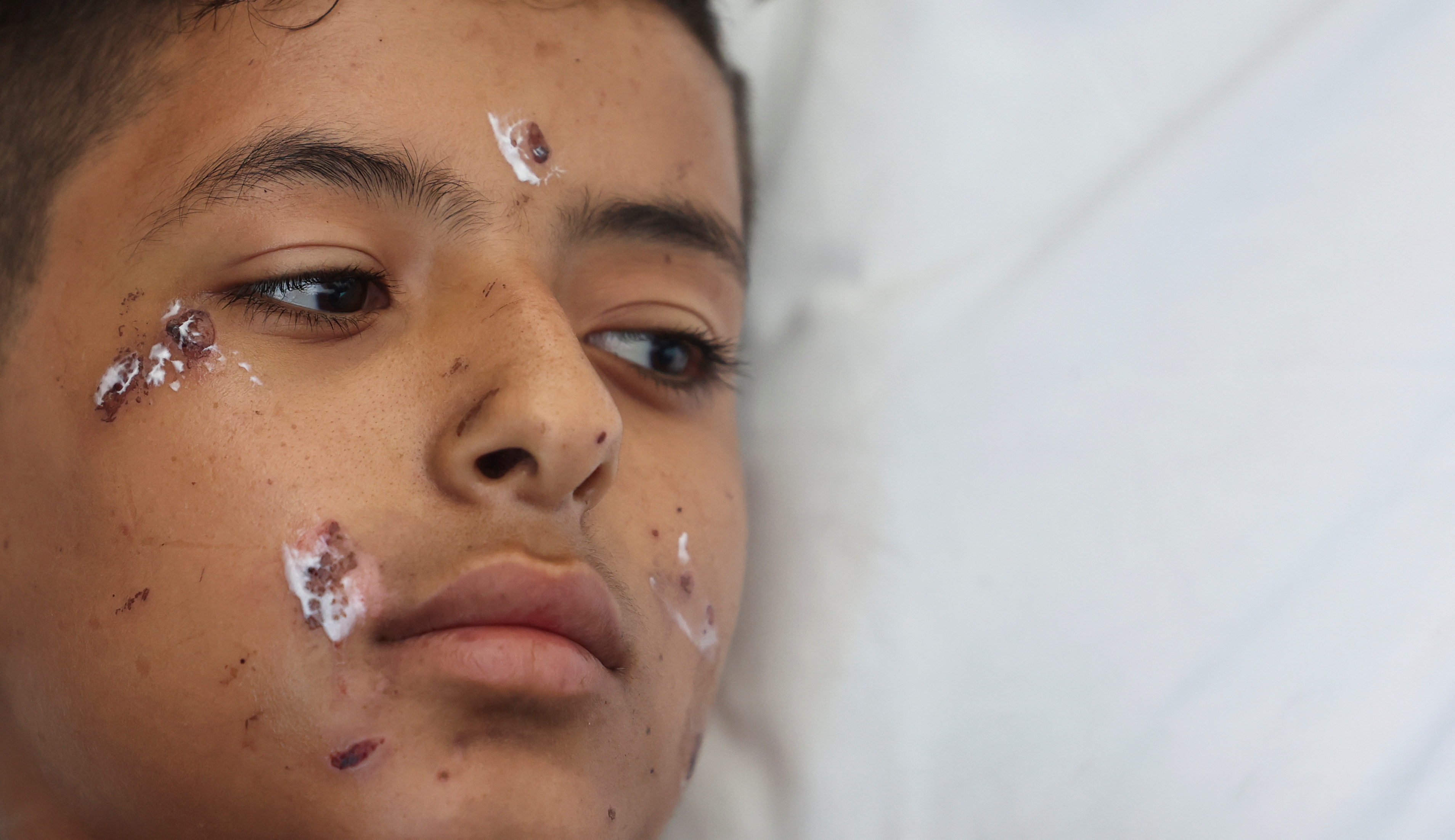 otrok, libanon, izrael, poškodovan