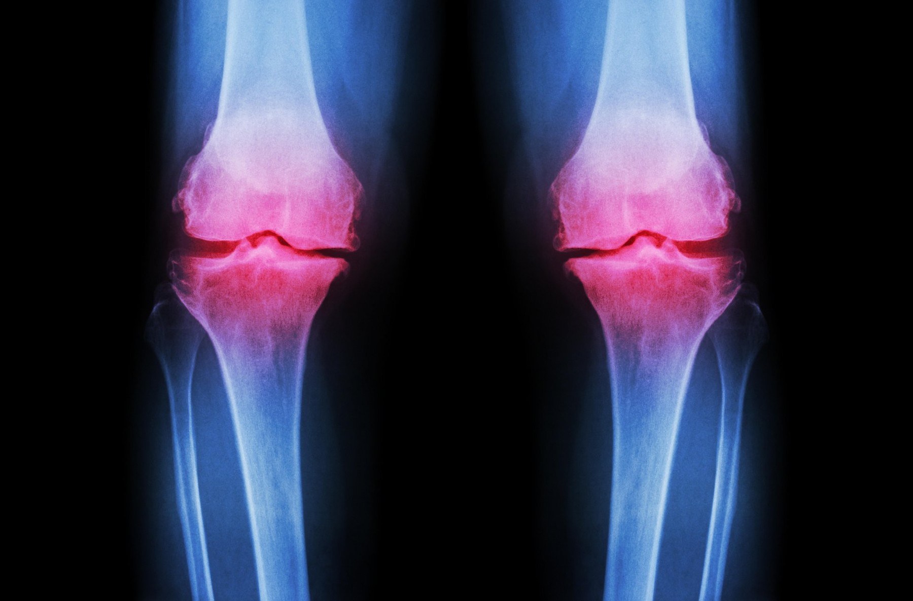 osteoartritis matične celice