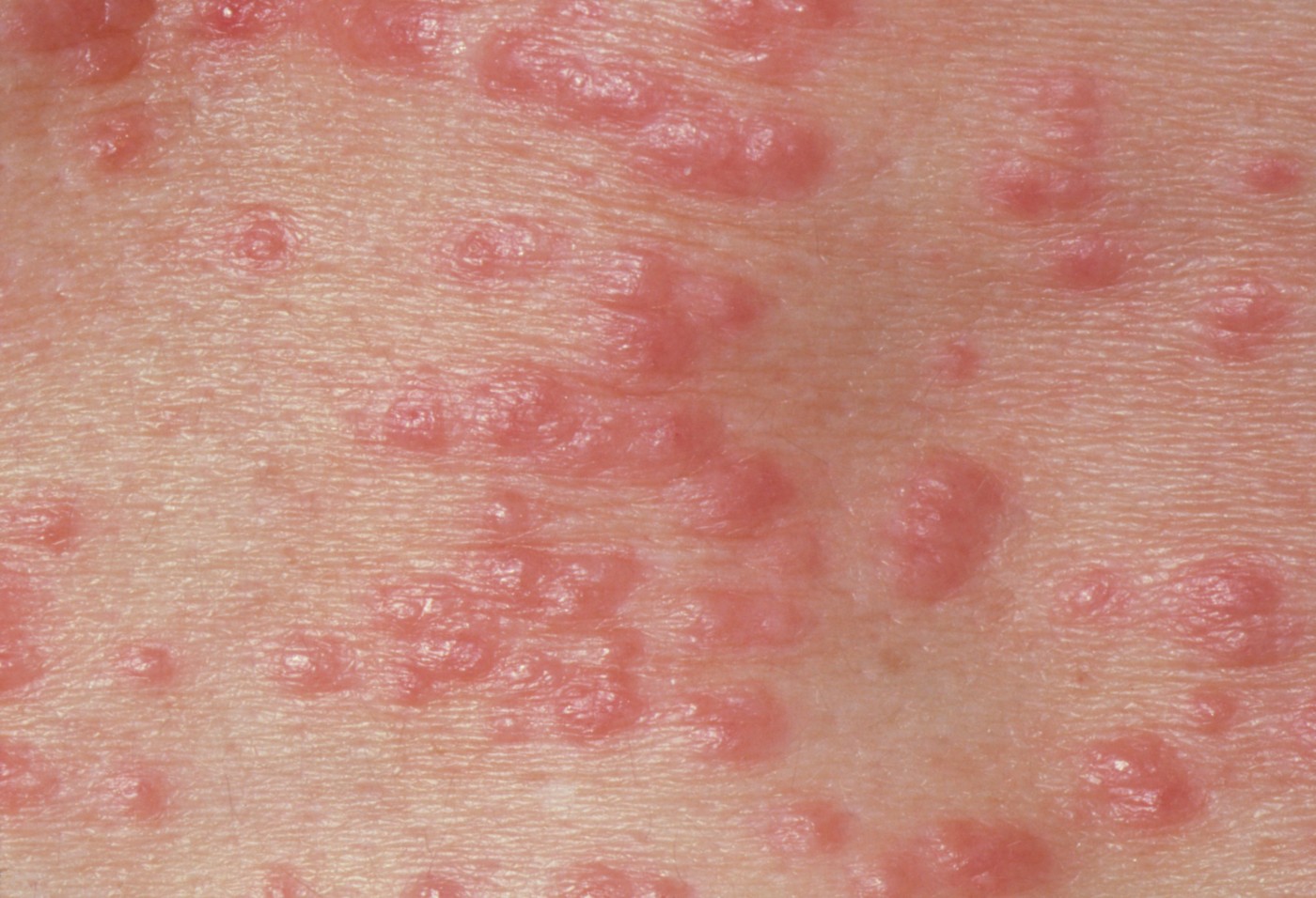 Red papules (lumps) on the skin due to scabies