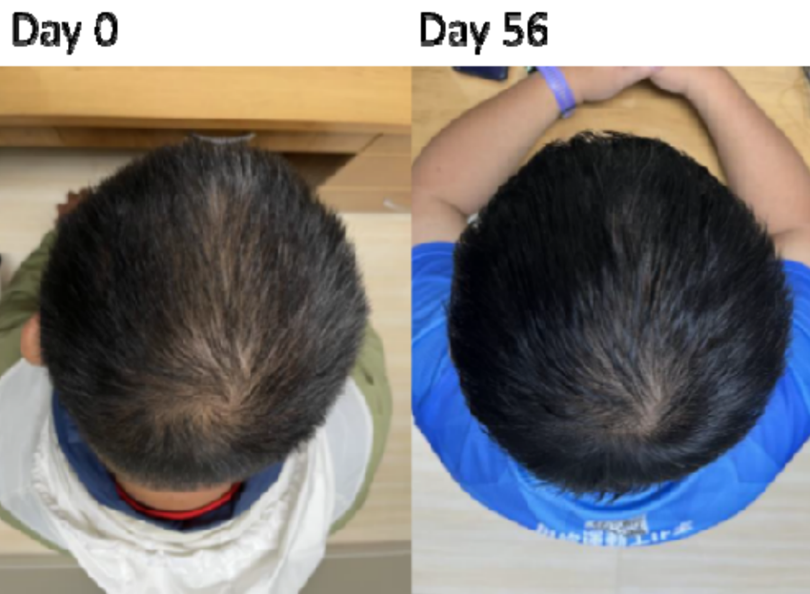 serum za zdravljenje izpadanja las