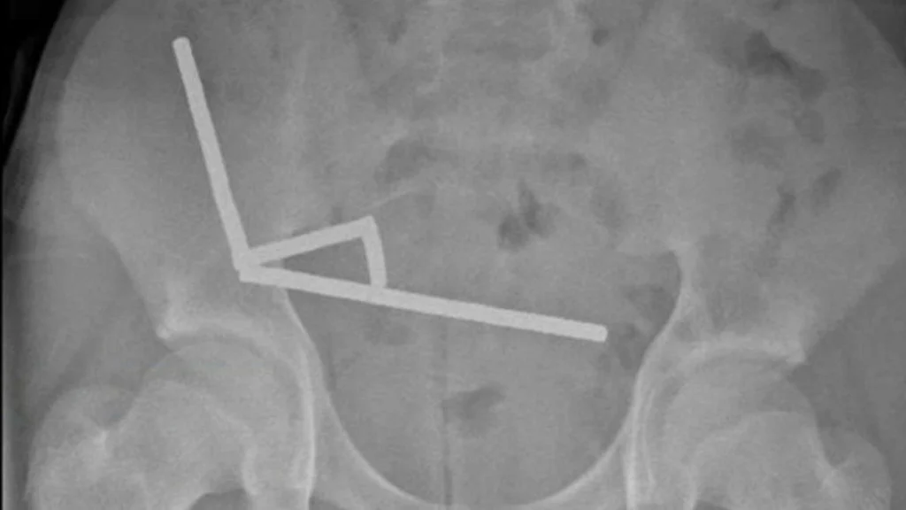 Dečka nujno sprejeli v bolnišnico. Kirurgi niso mogli verjeti, kaj so našli