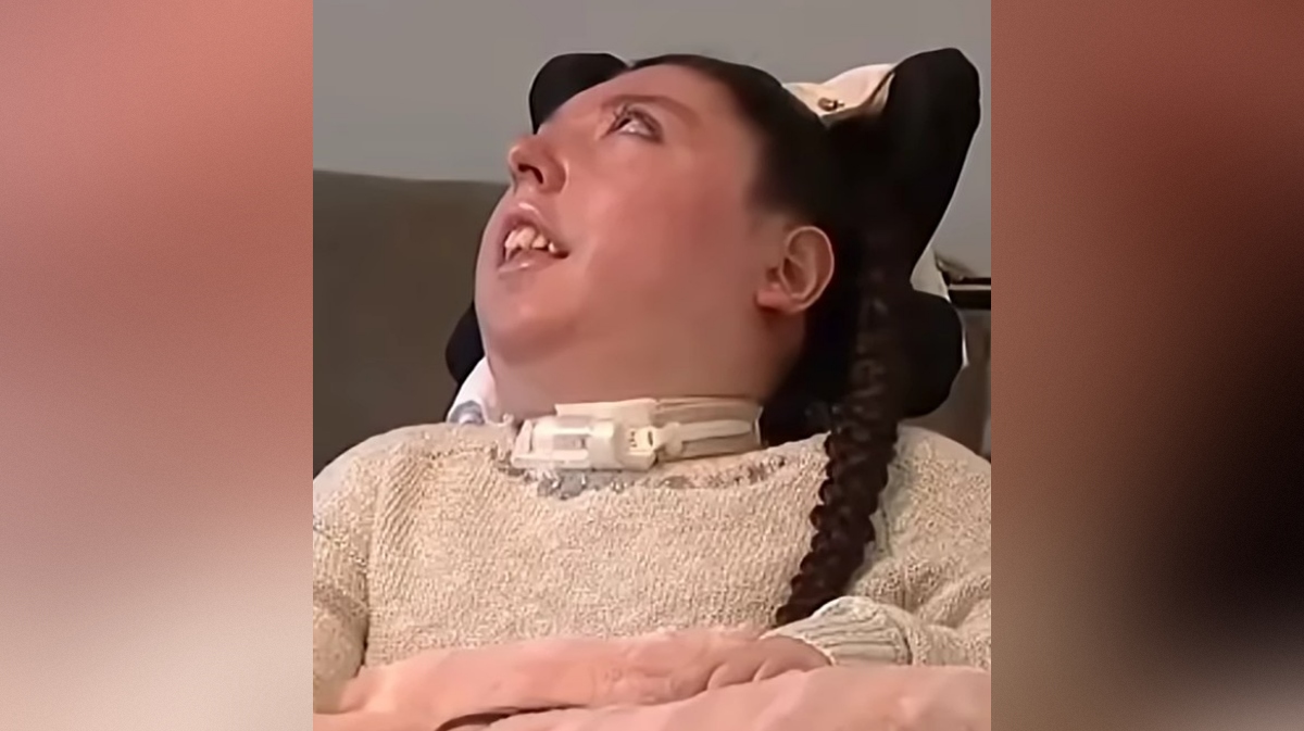 Alex Simpson ima hidranencefalijo, zaradi katere ji manjka velik del možganov.