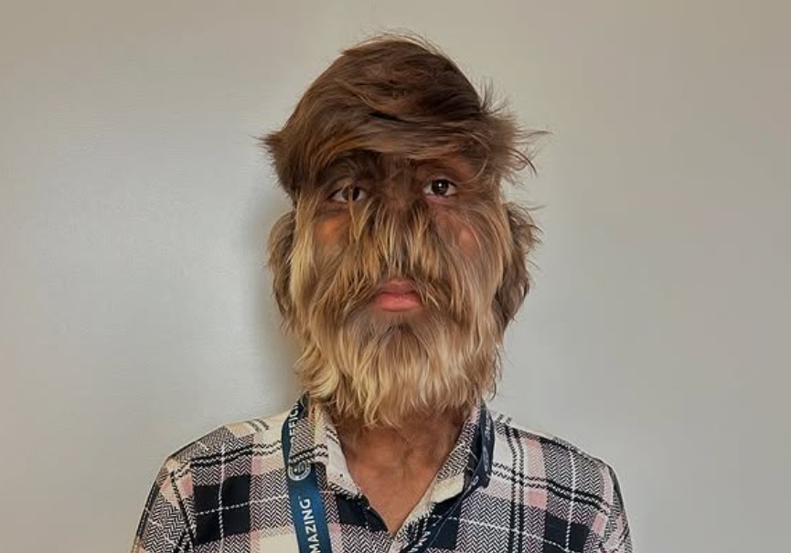 Lalit Patidar, moški z najbolj poraščenim obrazom na svetu, Indija