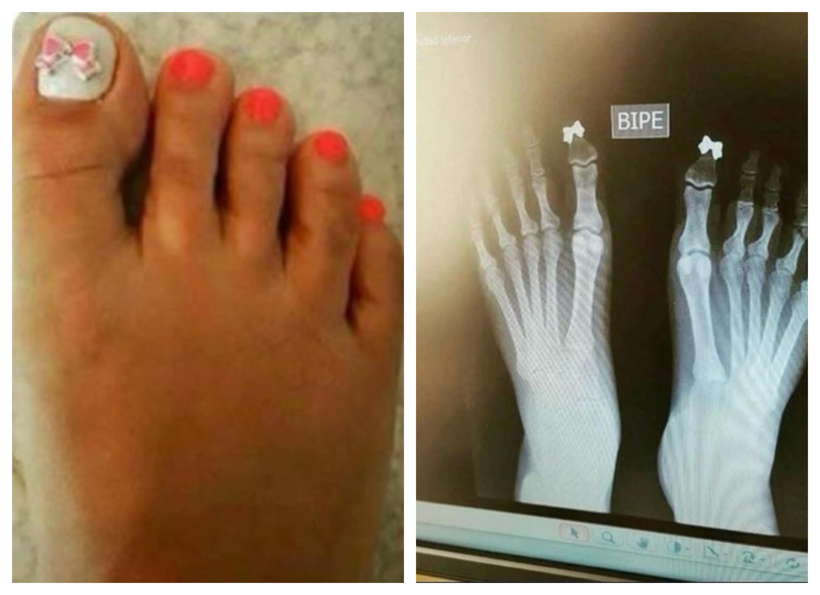 rentgenska slika, palec, noga, stopalo, viralno