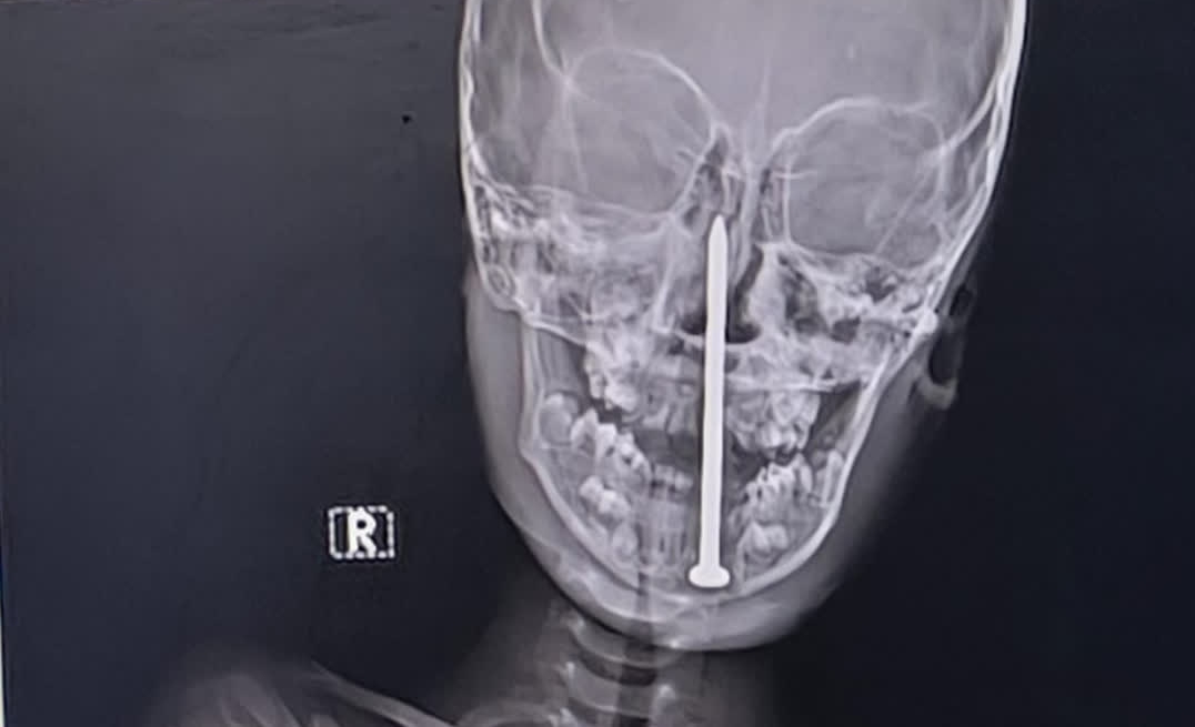 Rentgenski posnetek žeblja v dečkovi glavi.