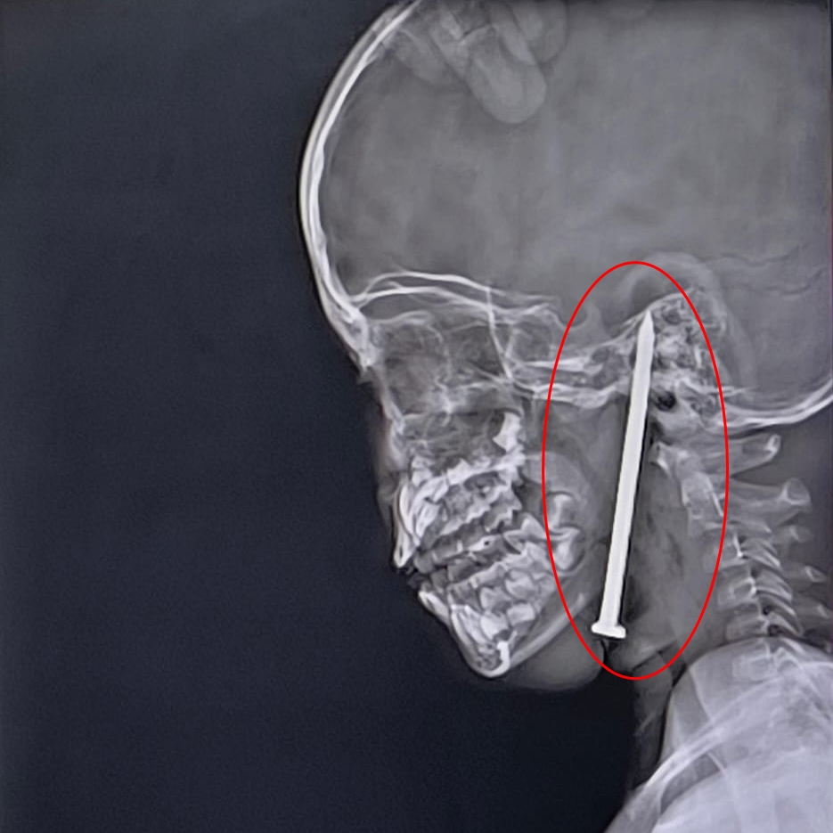Rentgenski posnetek žeblja v dečkovi glavi.