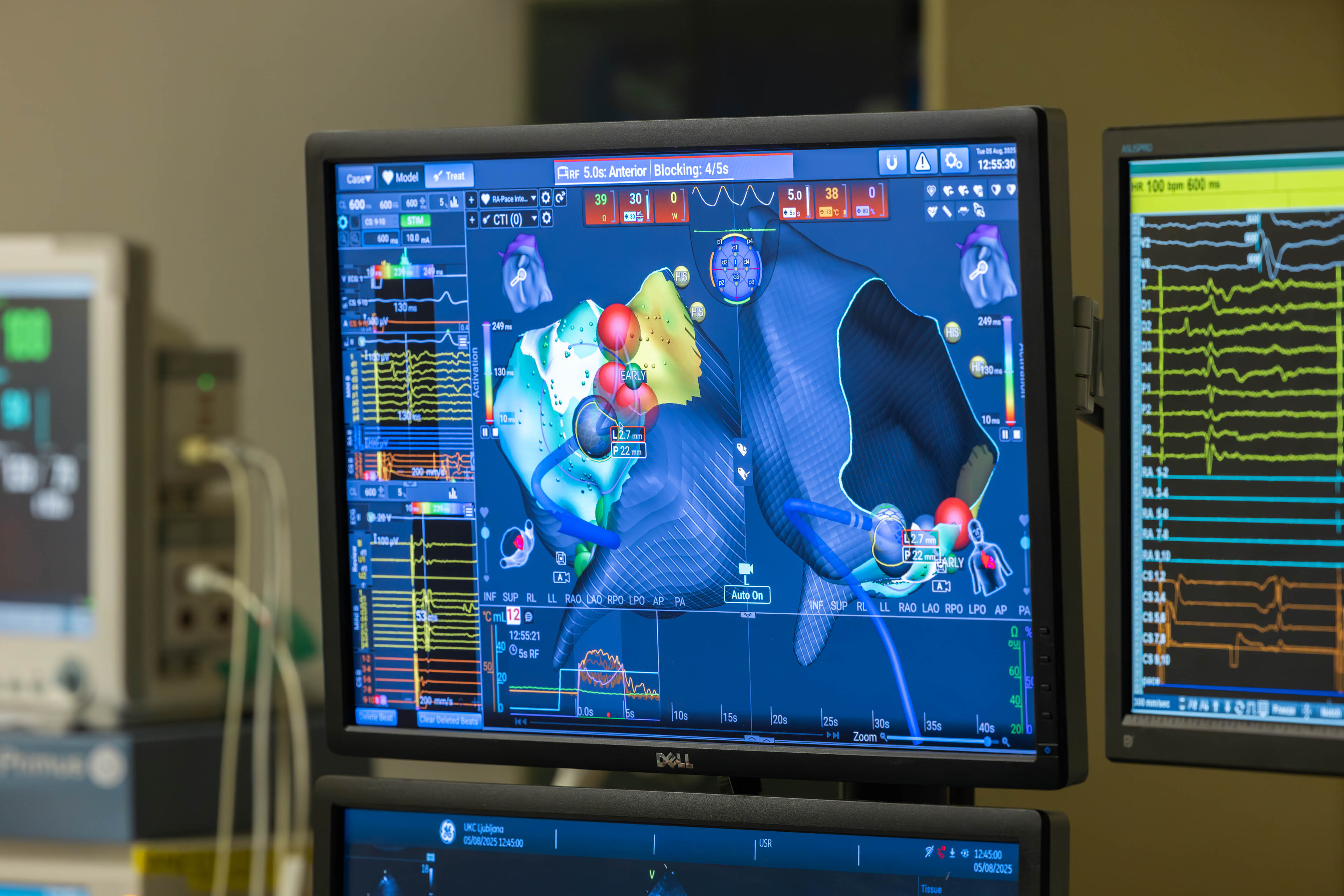 V Univerzitetnem kliničnem centru (UKC) Ljubljana so pridobili najsodobnejšo napravo za zdravljenje kompleksnih motenj srčnega ritma.