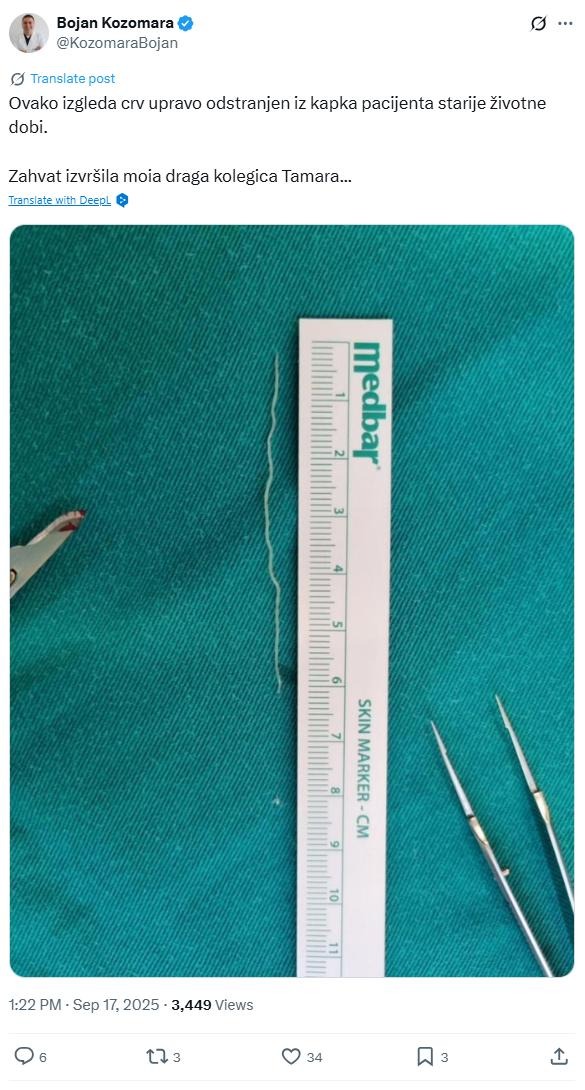 zdravniki izpod veke pacienta odstranili črva