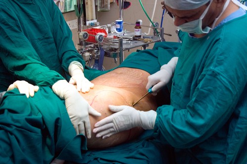 Fat loss by liposuction surgeries has become very common these days.,Image: 4183042, License: Rights-managed, Restrictions: , Model Release: no