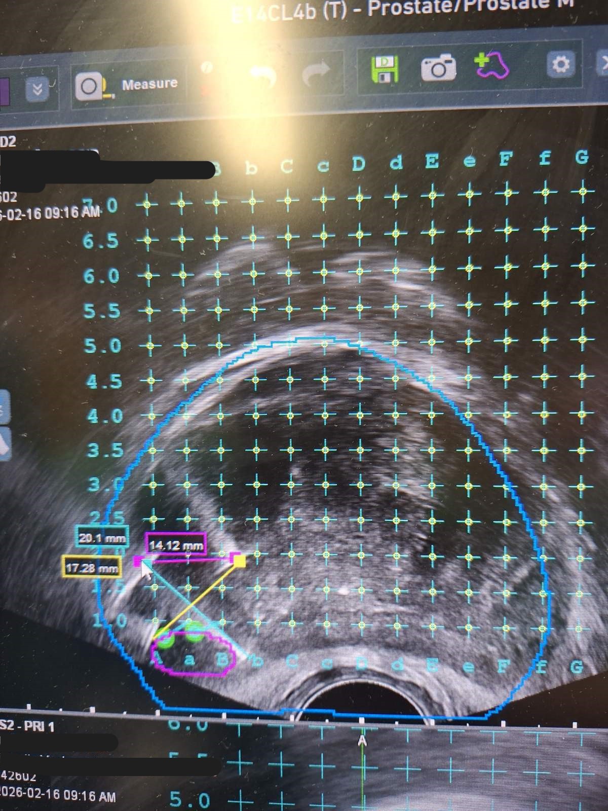 Fokalna terapija raka prostate