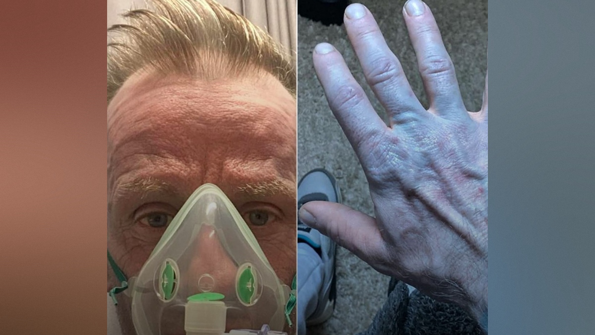 Tommy Lynch, ki je pomodrel čez noč, ker je spal na novih modrih neopranih rjuhah