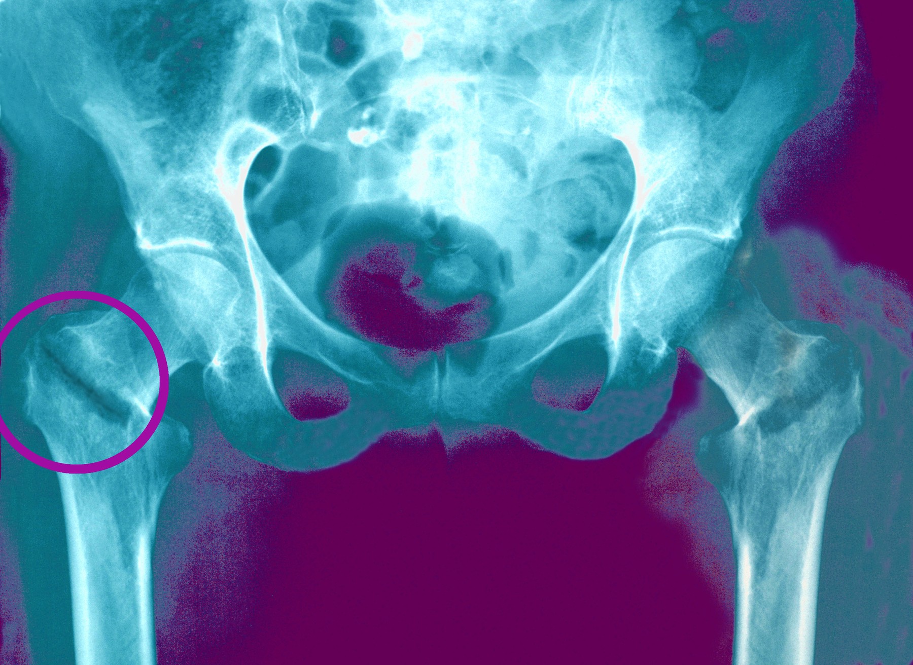 A coloured x ray image of a bilateral fractured neck of femur