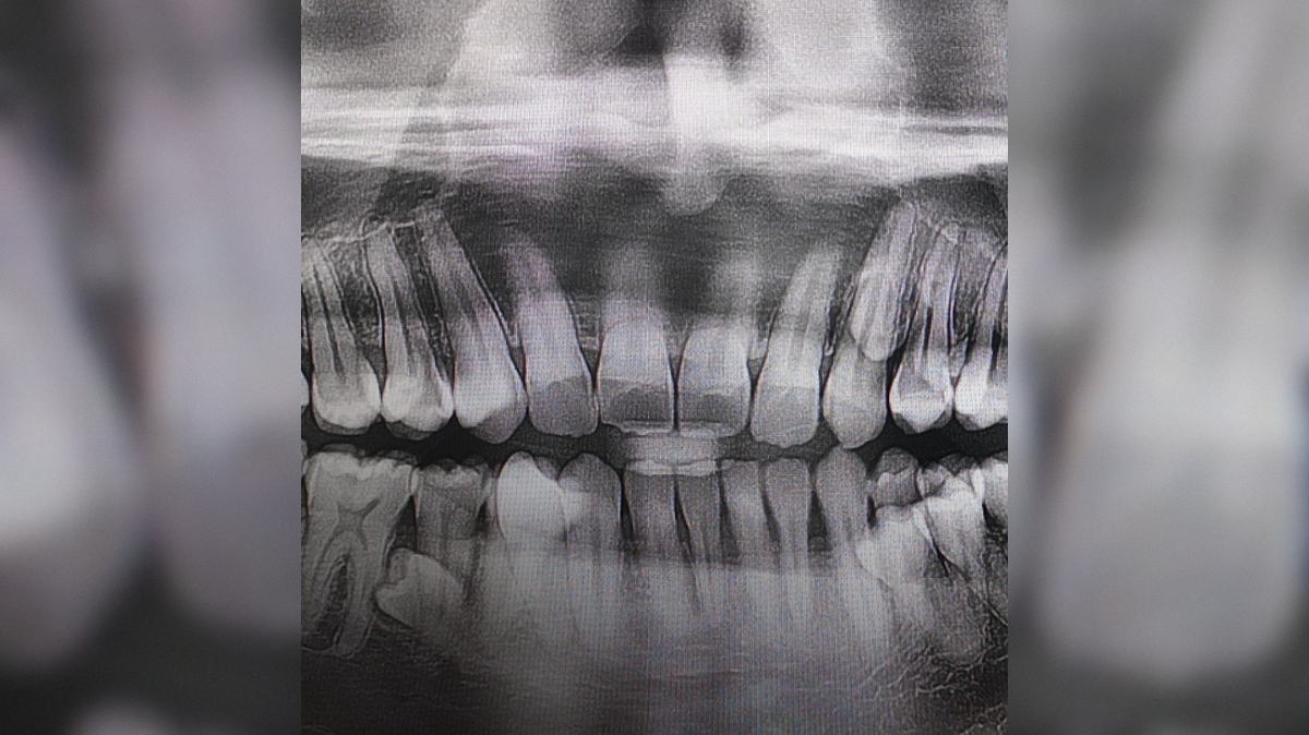 rentgenska slika zob