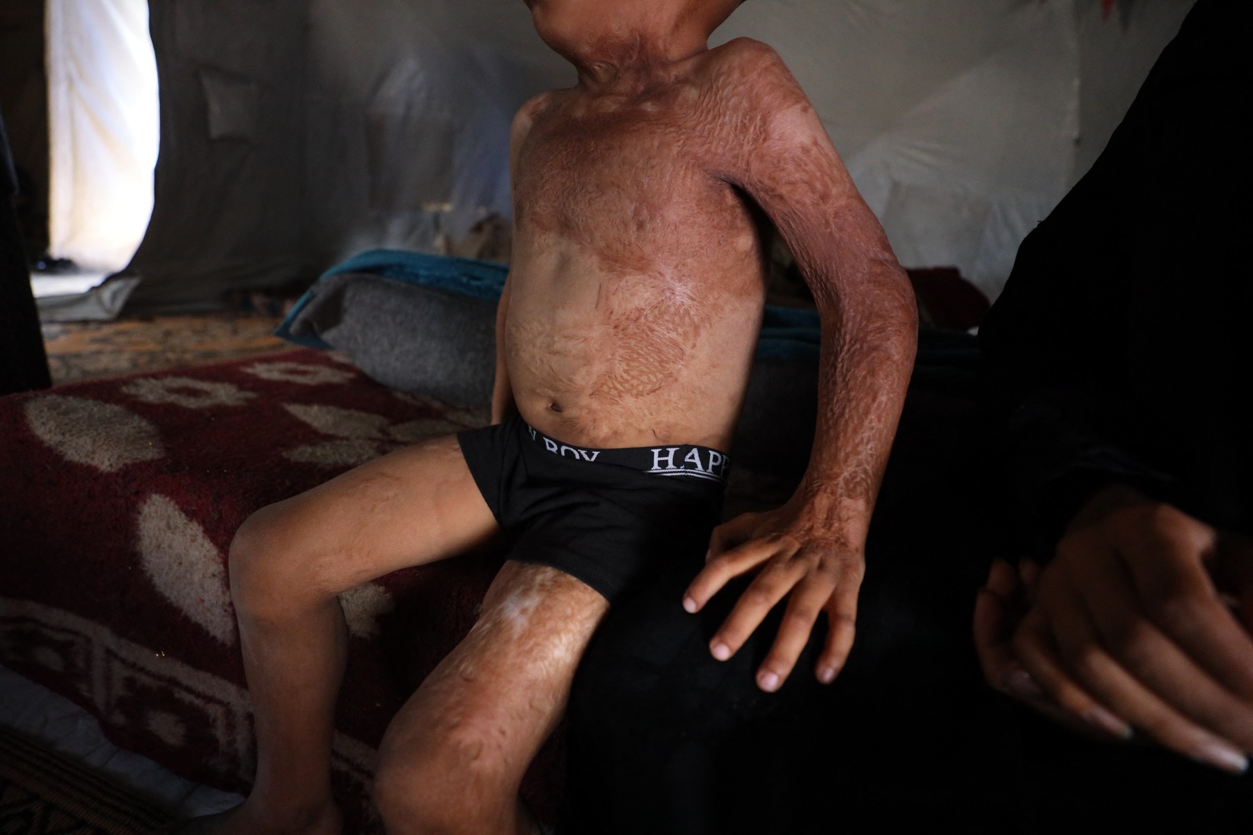 otrok z opeklinami v gazi