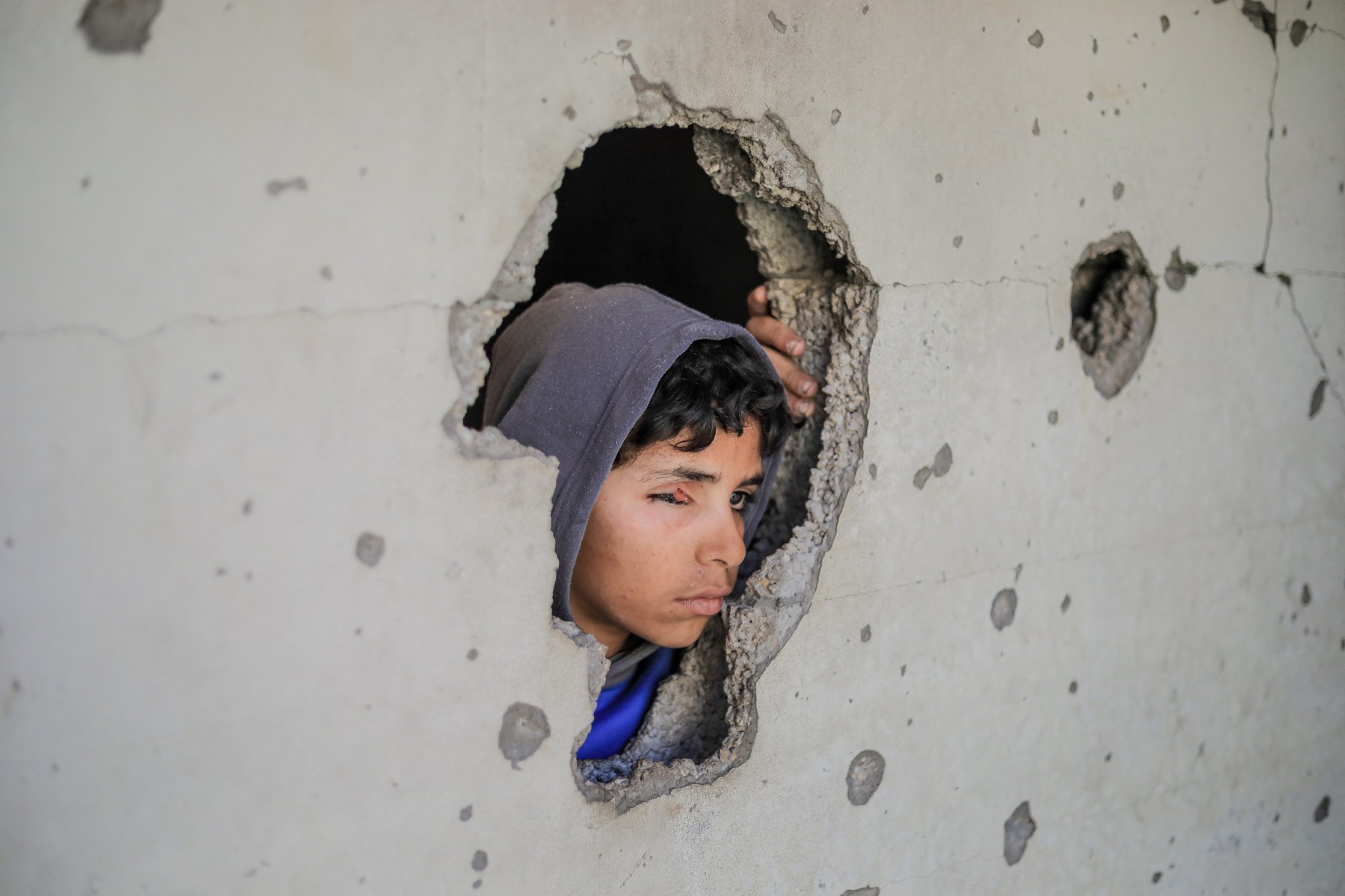 otrok, ki je izgubil oko