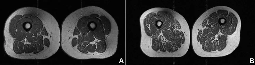 MR stegenske mišice