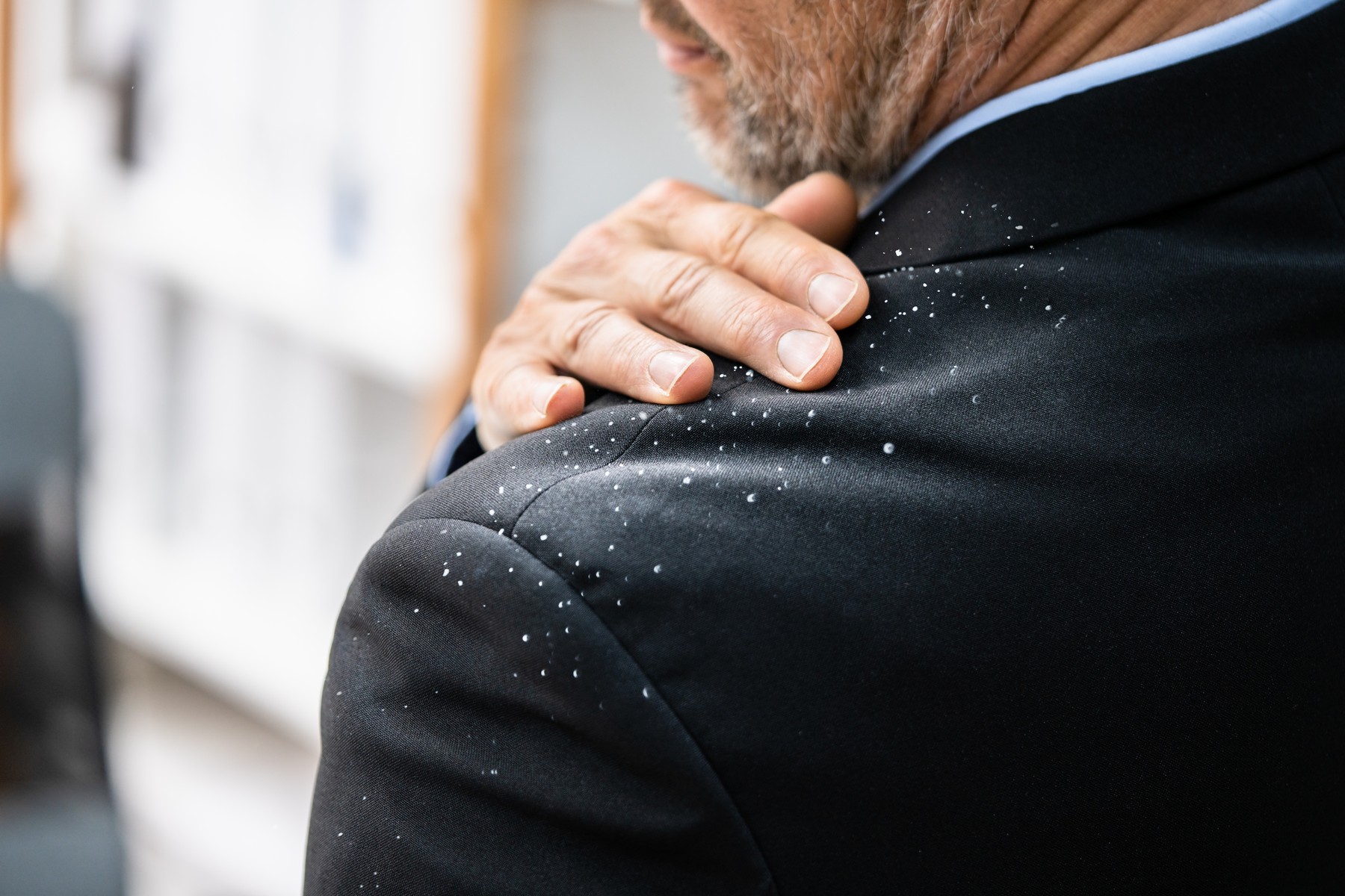 Man Dandruff On Suit Shoulder. Dirty Clothes,Image: 624026451, License: Royalty-free, Restrictions: , Model Release: yes