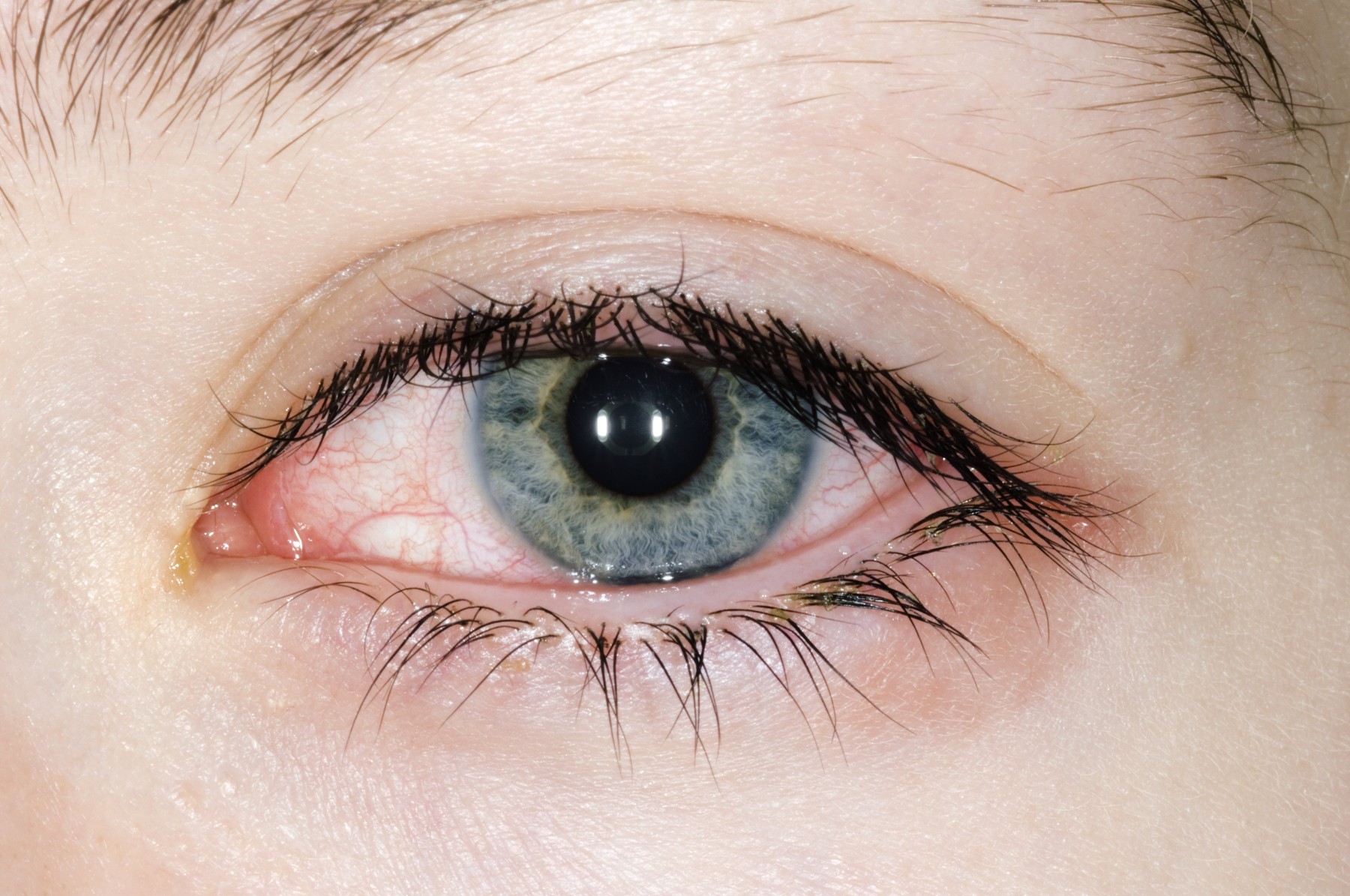 Allergic conjunctivitis in a 15 year old girl's eye. Conjunctivitis is an inflammation