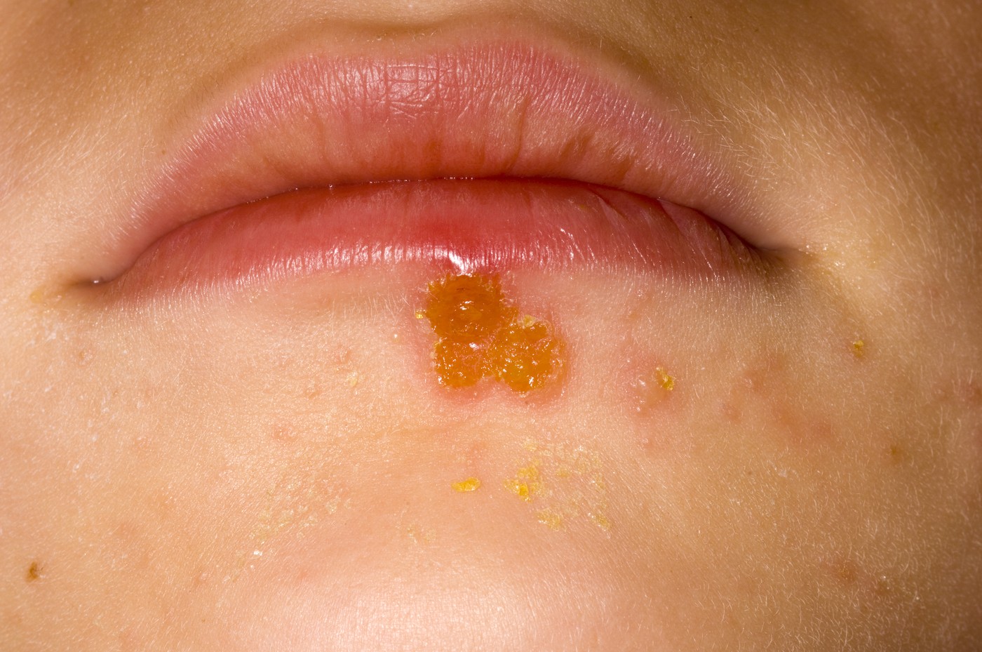 Impetigo