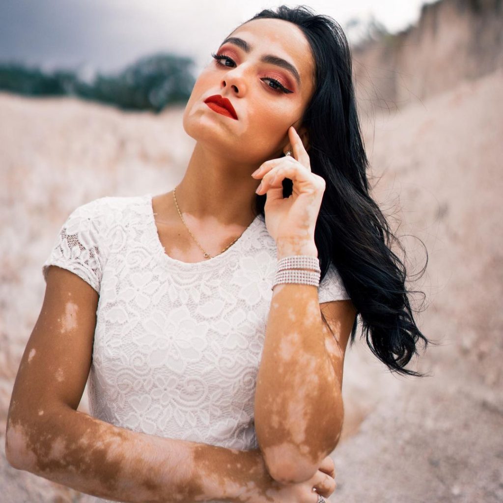 vitiligo, izguba kožnega pigmenta