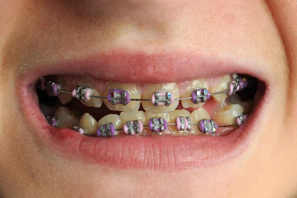 ortodont, zobni aparat