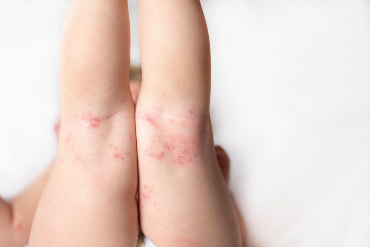 V Sarajevu razglasili epidemijo ošpic