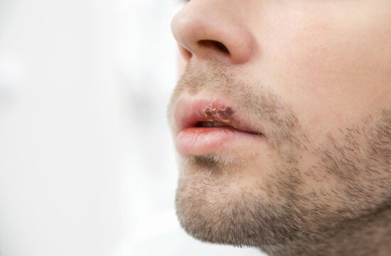 moški, navadni herpes. ustnice