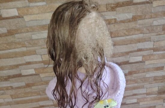 Pričeska triletne Srbkinje bega celo zdravnike, rastejo ji tri vrste las